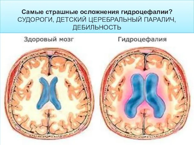 Самые страшные осложнения гидроцефалии? СУДОРОГИ, ДЕТСКИЙ ЦЕРЕБРАЛЬНЫЙ ПАРАЛИЧ, ДЕБИЛЬНОСТЬ