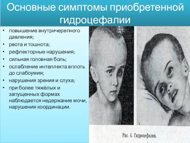 Основные симптомы приобретенной гидроцефалии повышение внутричерепного давления; рвота и тошнота; рефлекторные