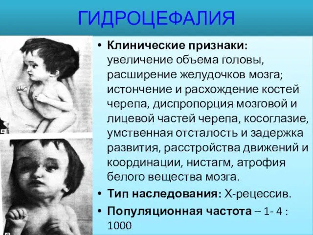 ГИДРОЦЕФАЛИЯ Клинические признаки: увеличение объема головы, расширение желудочков мозга; истончение и