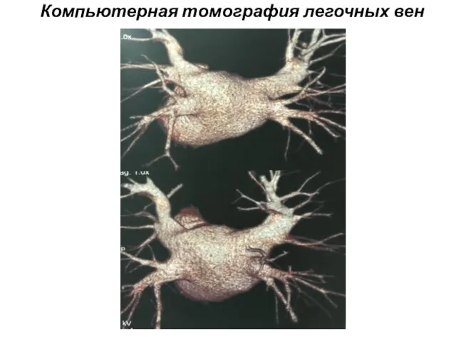 Компьютерная томография легочных вен