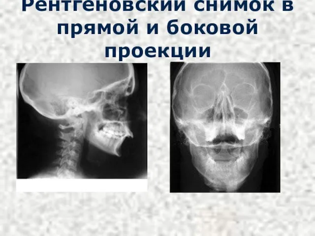 Рентгеновский снимок в прямой и боковой проекции
