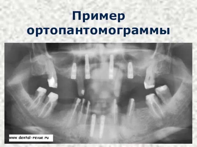 Пример ортопантомограммы