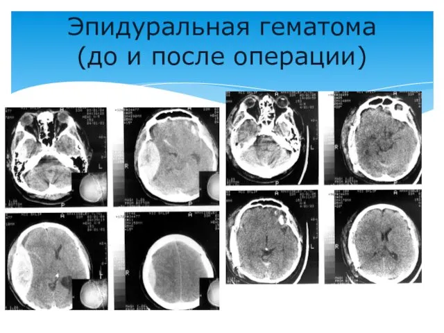 Эпидуральная гематома (до и после операции)