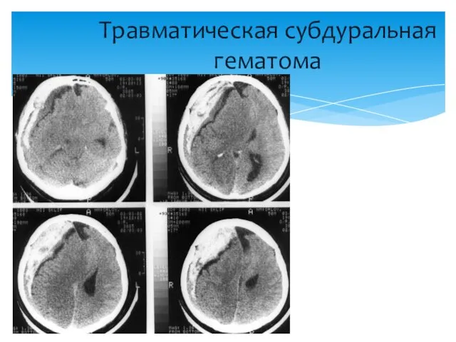 Травматическая субдуральная гематома