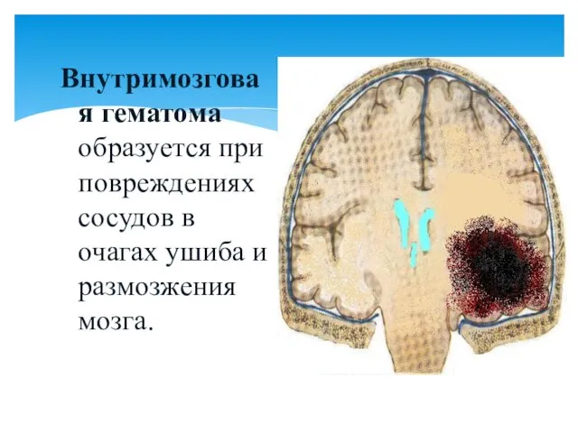 Внутримозговая гематома образуется при повреждениях сосудов в очагах ушиба и размозжения мозга.