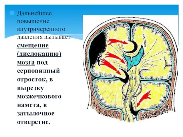 Дальнейшее повышение внутричерепного давления вызывает смещение (дислокацию) мозга под серповидный отросток,