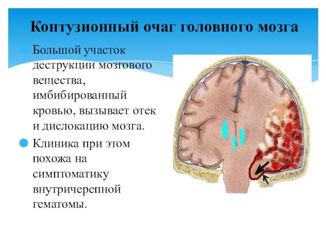 Контузионный очаг головного мозга Большой участок деструкции мозгового вещества, имбибированный кровью,