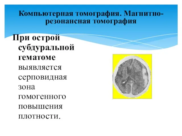 Компьютерная томография. Магнитно-резонансная томография При острой субдуральной гематоме выявляется серповидная зона гомогенного повышения плотности.