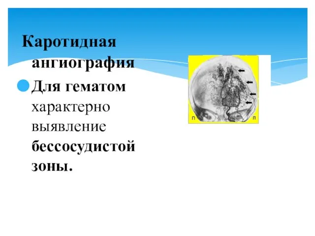 Каротидная ангиография Для гематом характерно выявление бессосудистой зоны.