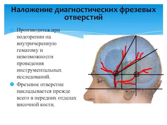 Наложение диагностических фрезевых отверстий Производится при подозрении на внутричерепную гематому и