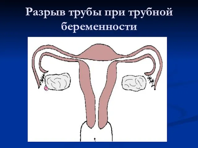 Разрыв трубы при трубной беременности