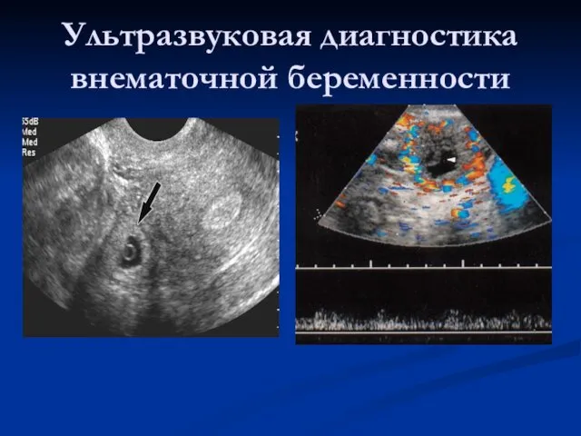 Ультразвуковая диагностика внематочной беременности