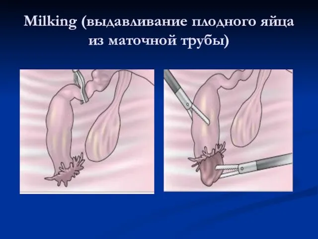 Milking (выдавливание плодного яйца из маточной трубы)