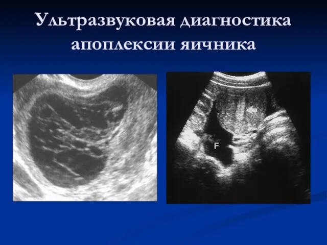 Ультразвуковая диагностика апоплексии яичника