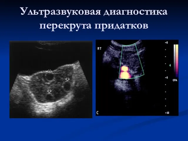 Ультразвуковая диагностика перекрута придатков