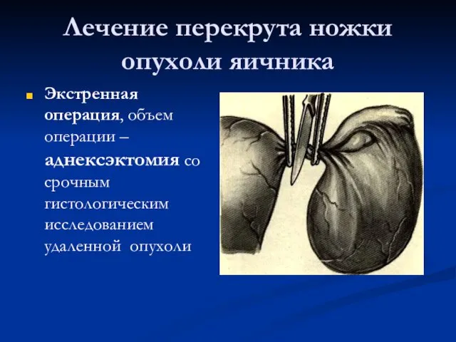 Лечение перекрута ножки опухоли яичника Экстренная операция, объем операции – аднексэктомия