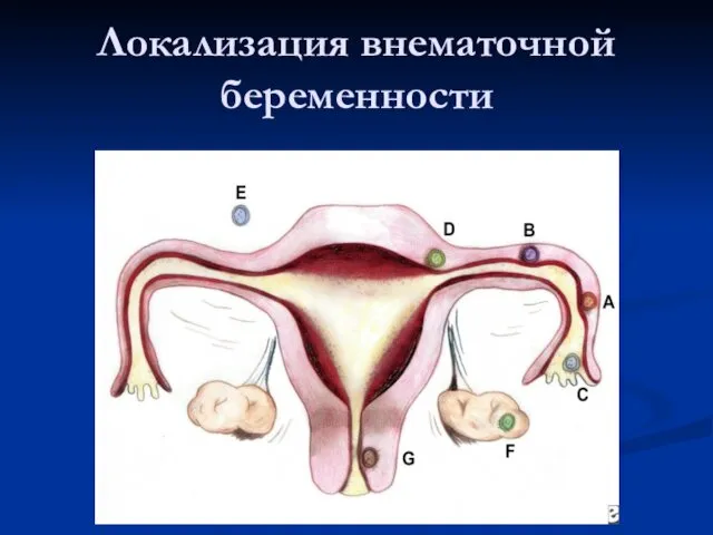 Локализация внематочной беременности