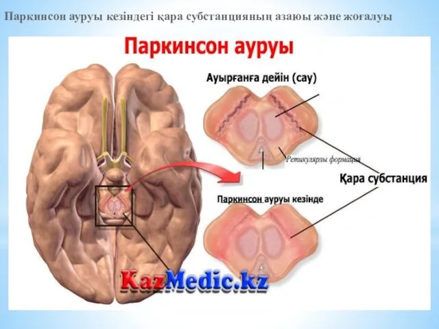 Паркинсон ауруы кезіндегі қара субстанцияның азаюы және жоғалуы