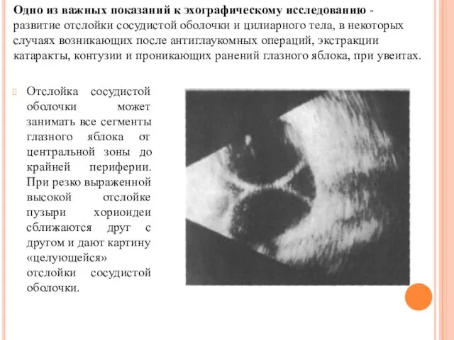 Отслойка сосудистой оболочки может занимать все сегменты глазного яблока от центральной