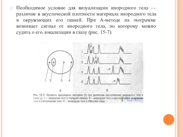 Необходимое условие для визуализации инородного тела — различие в акустической плотности