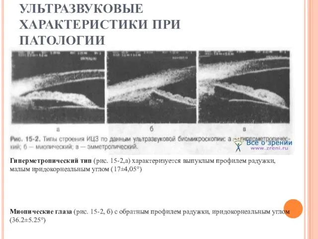 УЛЬТРАЗВУКОВЫЕ ХАРАКТЕРИСТИКИ ПРИ ПАТОЛОГИИ Гиперметропический тип (рис. 15-2,а) характеризуется выпуклым профилем