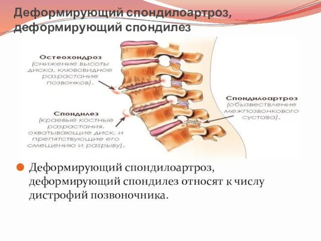 Деформирующий спондилоартроз, деформирующий спондилез Деформирующий спондилоартроз, деформирующий спондилез относят к числу дистрофий позвоночника.