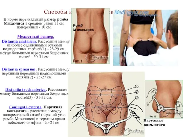 Способы измерения женского таза В норме вертикальный размер ромба Михаэлиса в