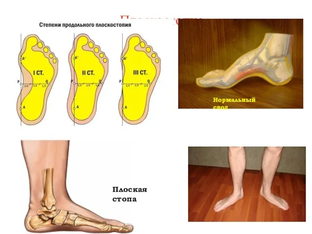 Плоскостопие Нормальный свод Плоская стопа