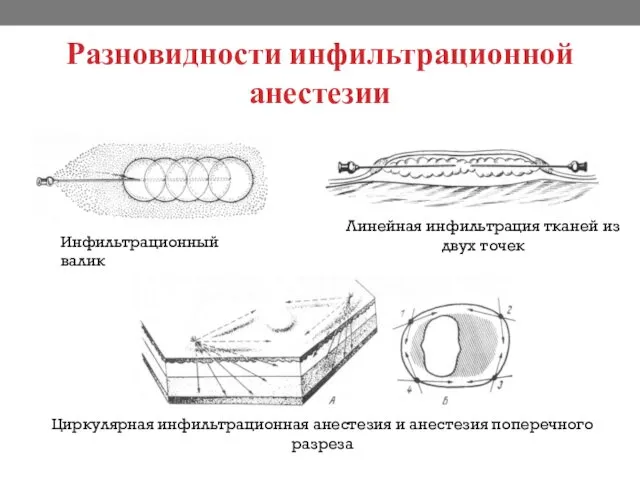 Разновидности инфильтрационной анестезии Инфильтрационный валик Линейная инфильтрация тканей из двух точек