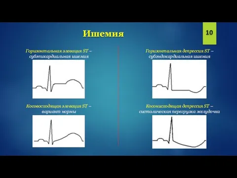 Ишемия 10 Горизонтальная элевация ST – субэпикардиальная ишемия Косовосходящая элевация ST