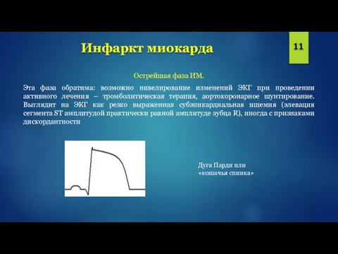 Инфаркт миокарда 11 Острейшая фаза ИМ. Эта фаза обратима: возможно нивелирование