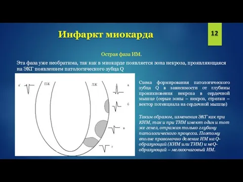 Инфаркт миокарда 12 Острая фаза ИМ. Эта фаза уже необратима, так