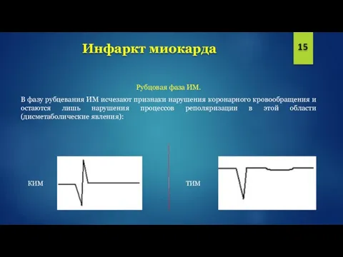 Инфаркт миокарда 15 Рубцовая фаза ИМ. В фазу рубцевания ИМ исчезают