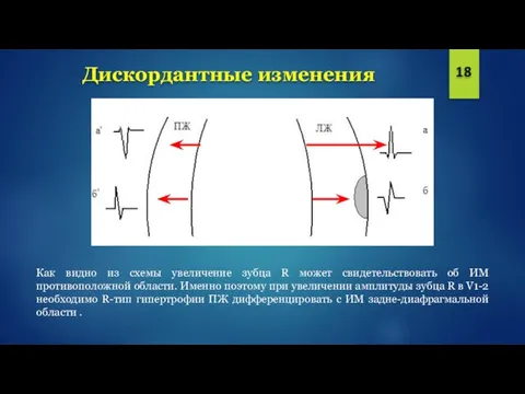 Дискордантные изменения 18 Как видно из схемы увеличение зубца R может