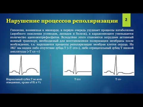 Нарушение процессов реполяризации Гипоксия, возникшая в миокарде, в первую очередь ухудшает