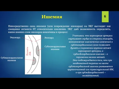 Ишемия Непосредственно сама ишемия (или повреждение миокарда) на ЭКГ выглядит как