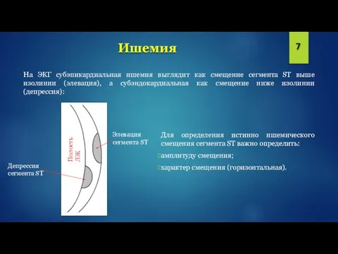 Ишемия На ЭКГ субэпикардиальная ишемия выглядит как смещение сегмента ST выше