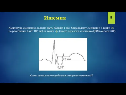 Ишемия Амплитуда смещения должна быть больше 1 мм. Определяют смещение в