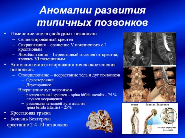 Аномалии развития типичных позвонков Изменение числа свободных позвонков Сегментированный крестец Сакрализация