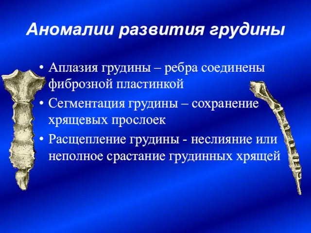 Аномалии развития грудины Аплазия грудины – ребра соединены фиброзной пластинкой Сегментация