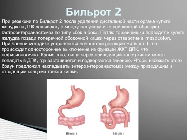 Бильрот 2 При резекции по Бильрот 2 после удаления дистальной части