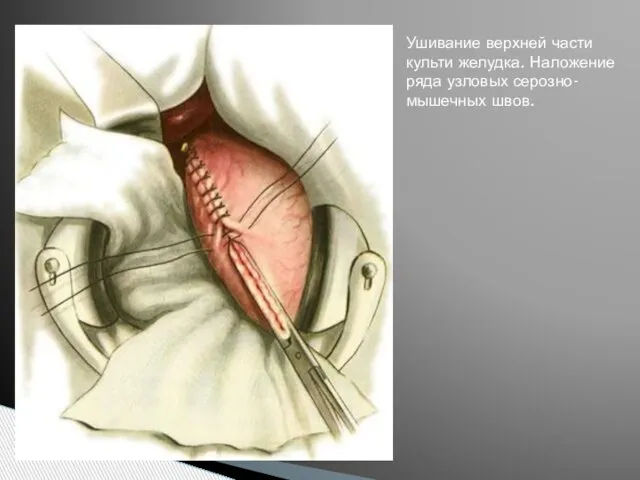 Ушивание верхней части культи желудка. Наложение ряда узловых серозно-мышечных швов.