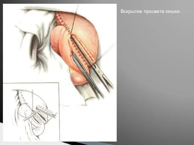 Вскрытие просвета кишки.
