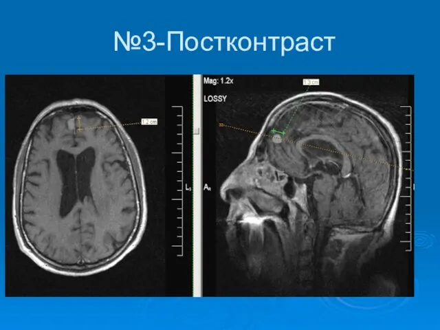 №3-Постконтраст