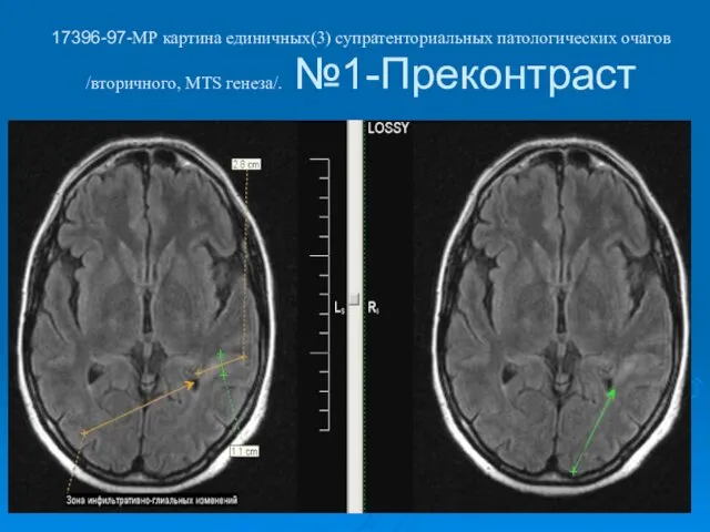 17396-97-МР картина единичных(3) супратенториальных патологических очагов /вторичного, МТS генеза/. №1-Преконтраст