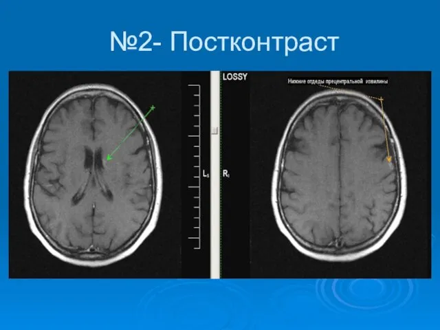 №2- Постконтраст