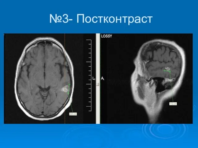 №3- Постконтраст