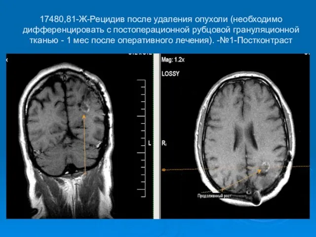 17480,81-Ж-Рецидив после удаления опухоли (необходимо дифференцировать с постоперационной рубцовой грануляционной тканью