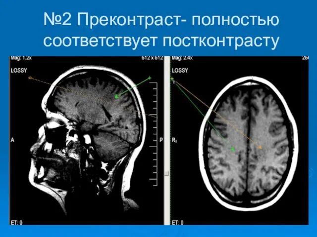 №2 Преконтраст- полностью соответствует постконтрасту