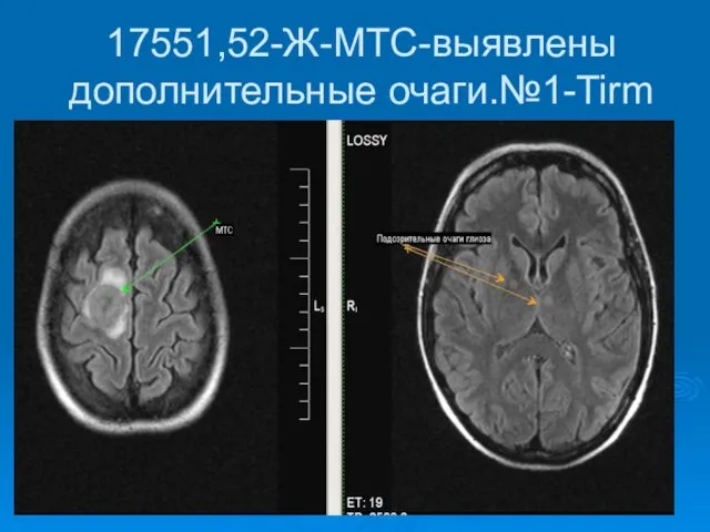 17551,52-Ж-МТС-выявлены дополнительные очаги.№1-Tirm